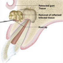 An apicoectomy procedure is performed