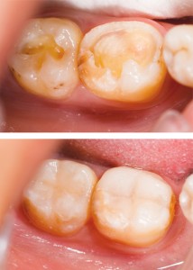 Before and After Treatment